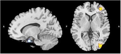 Atypical Brain Structures as a Function of Gray Matter Volume (GMV) and Gray Matter Density (GMD) in Young Adults Relating to Autism Spectrum Traits